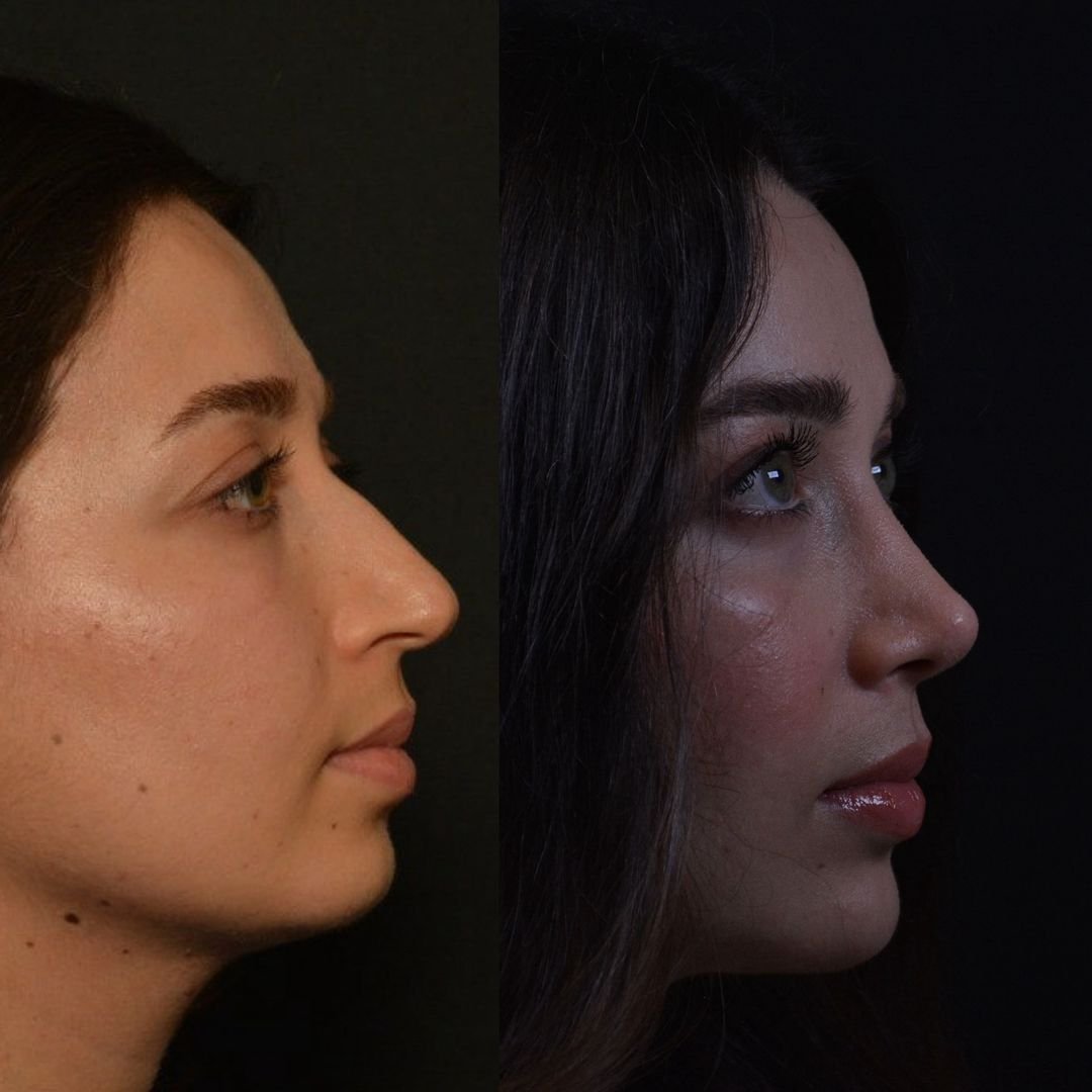 How Does Rhinoplasty Work Rhinoplasty (Nose Job) in Istanbul, Turkey - Op. Dr. Alev Camcıoğlu