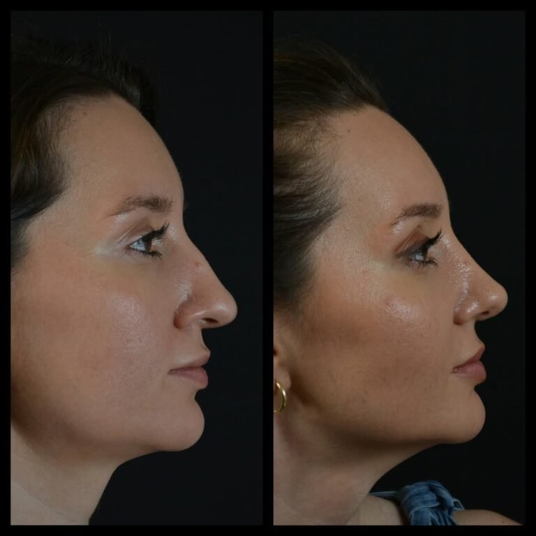 How Does Rhinoplasty Work Rhinoplasty (Nose Job) in Istanbul, Turkey - Op. Dr. Alev Camcıoğlu