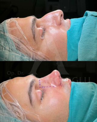 Revizijska rinoplastika