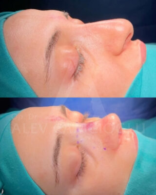Revizijska rinoplastika