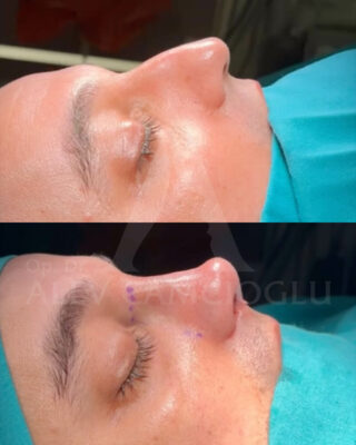 Revizijska rinoplastika