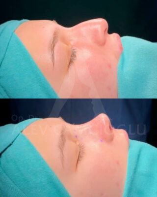 Revizijska rinoplastika