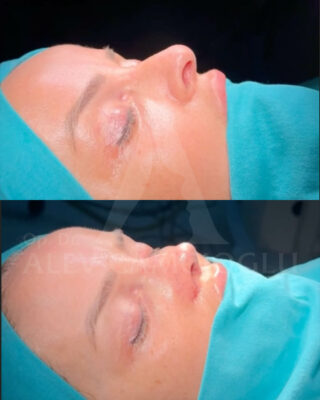 Revizijska rinoplastika