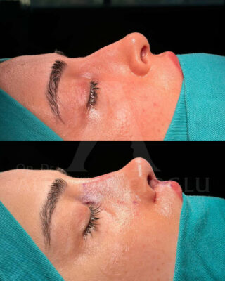 Revizijska rinoplastika