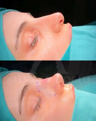 Revizijska rinoplastika