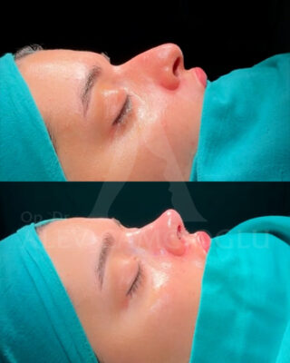 Revizijska rinoplastika