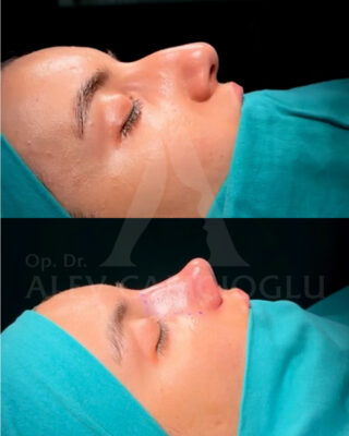 Revizijska rinoplastika