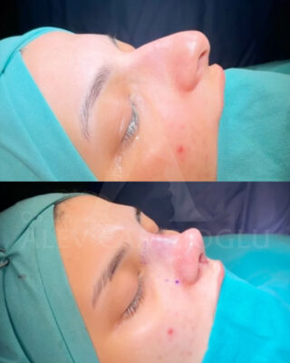 Revizijska rinoplastika
