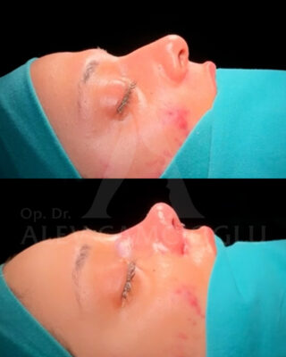 Revizijska rinoplastika