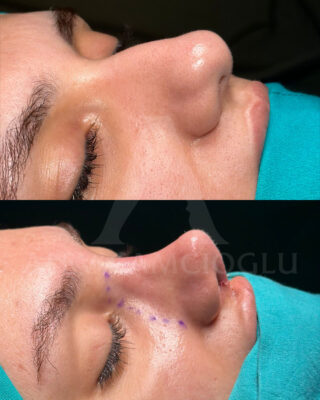 Revizijska rinoplastika