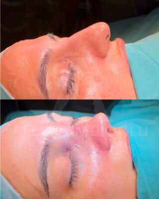 Revizijska rinoplastika