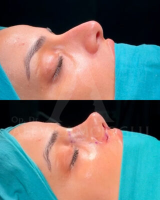 Revizijska rinoplastika
