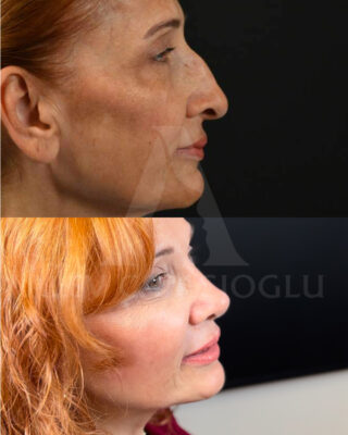 Revizijska rinoplastika