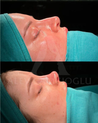 Revizijska rinoplastika