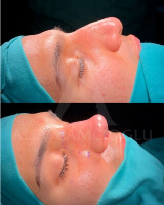 Revizijska rinoplastika