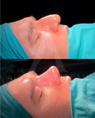 Revizijska rinoplastika