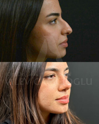 Revizijska rinoplastika