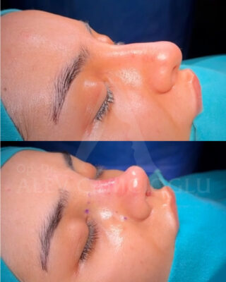 Revizijska rinoplastika