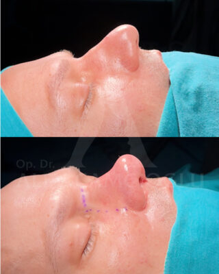 Revizijska rinoplastika