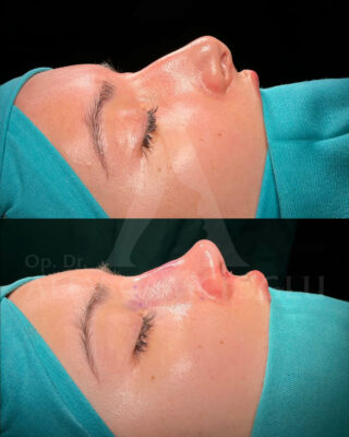 Revizijska rinoplastika