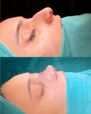 Revizijska rinoplastika