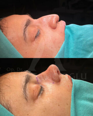 Revizijska rinoplastika