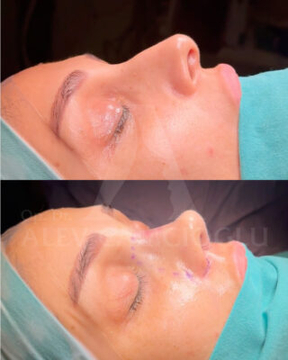 Revizijska rinoplastika