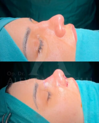 Revizijska rinoplastika