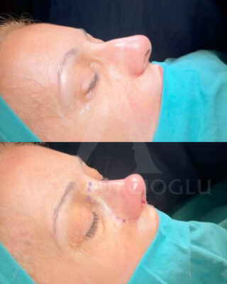 Revizijska rinoplastika