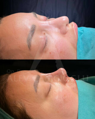 Revizijska rinoplastika