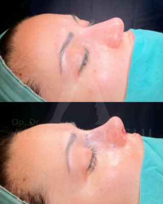 Revizijska rinoplastika