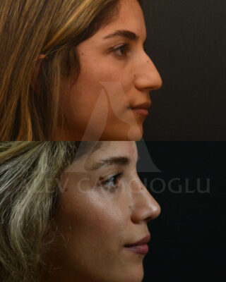 Revizijska rinoplastika